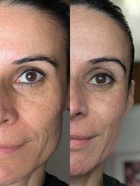 Una sola sesión de Microneedling. Antes Vs Después